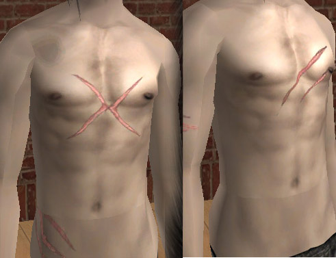 chest scar